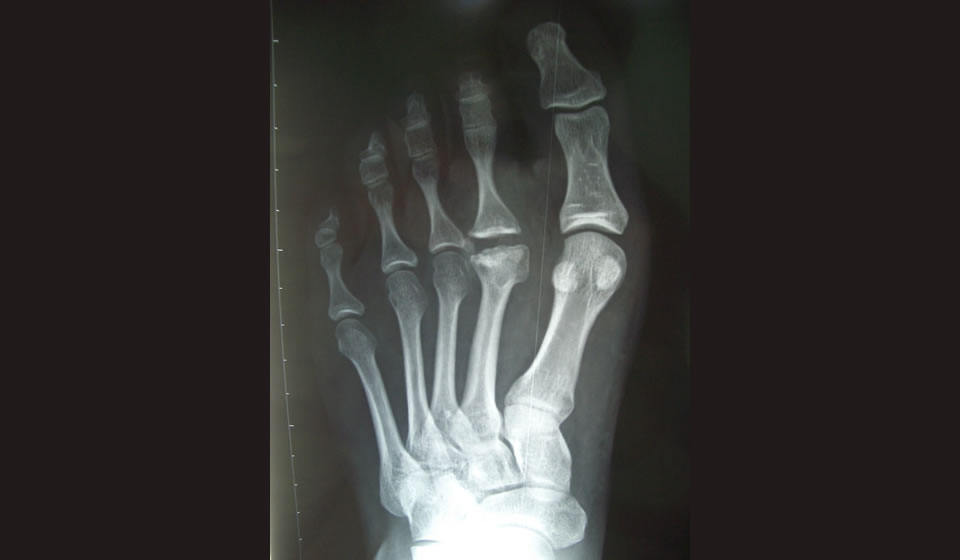 Enfermedad de Freiberg