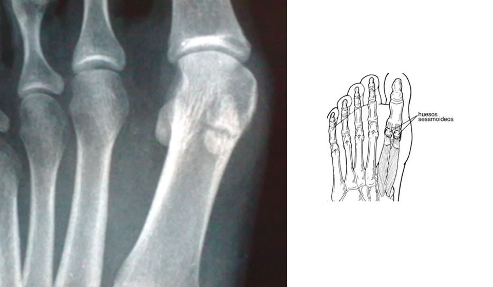 Huesos sesamoideos del Hallux - 2a parte Huesos sesamoideos del Hallux - 2a parte